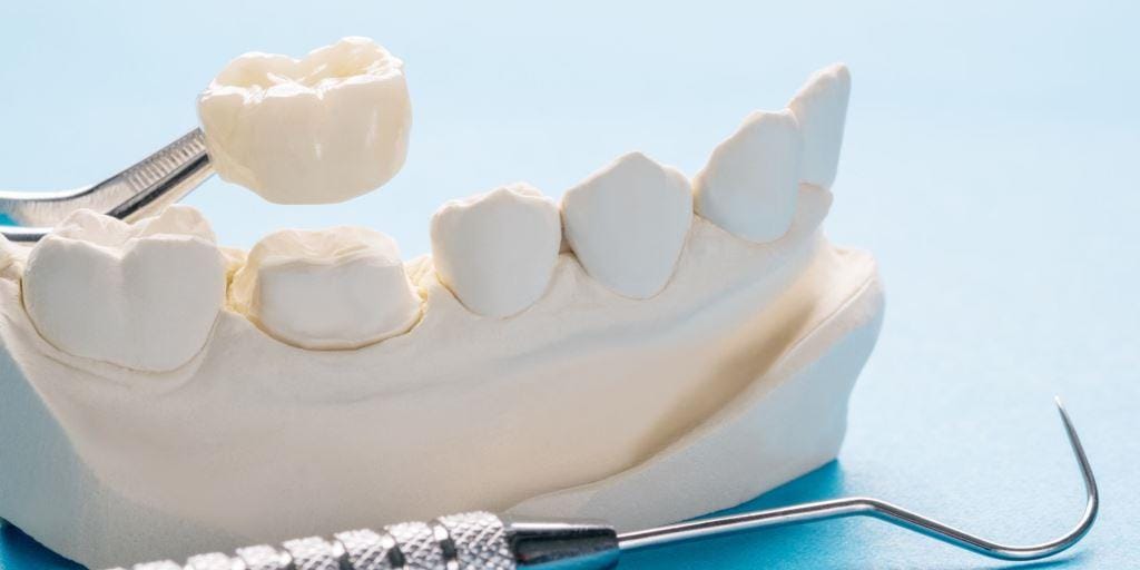 A crown held above a prepared tooth on a model