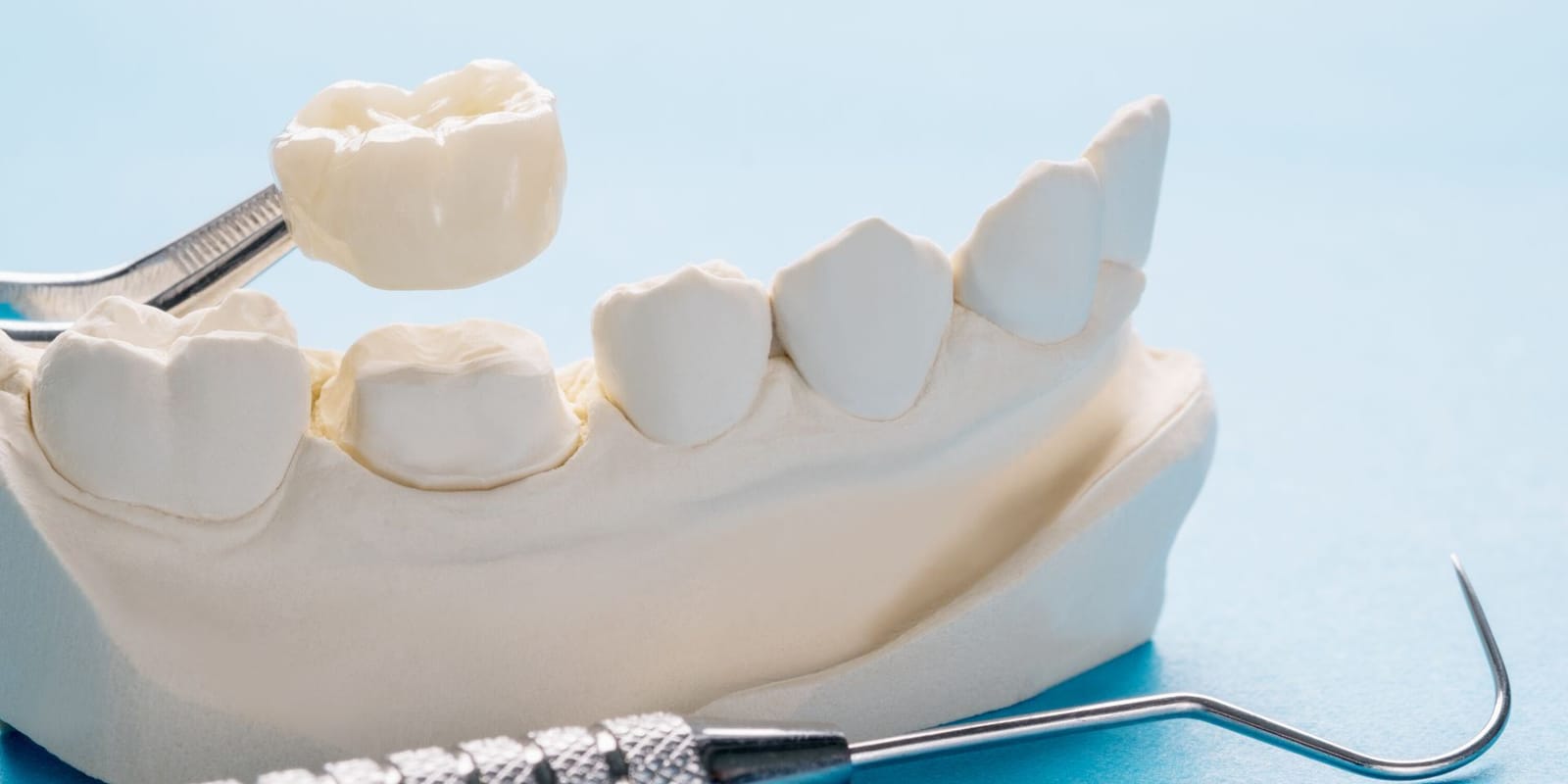 A crown held above a prepared tooth on a dental model