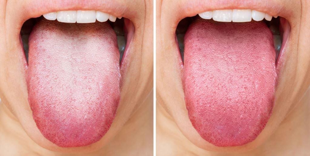 Two close-up photographs of a tongue