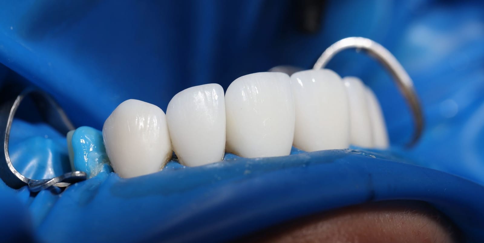 Front teeth isolated with a blue dental dam during treatment
