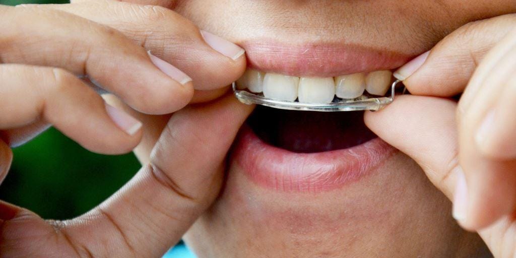 A person fitting a removable retainer over their upper teeth