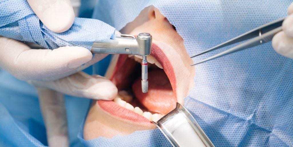 Dental handpiece positioned near a patient’s mouth during treatment