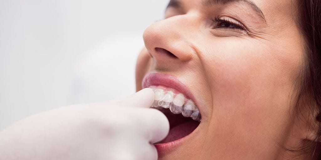 A clear dental tray being fitted over teeth
