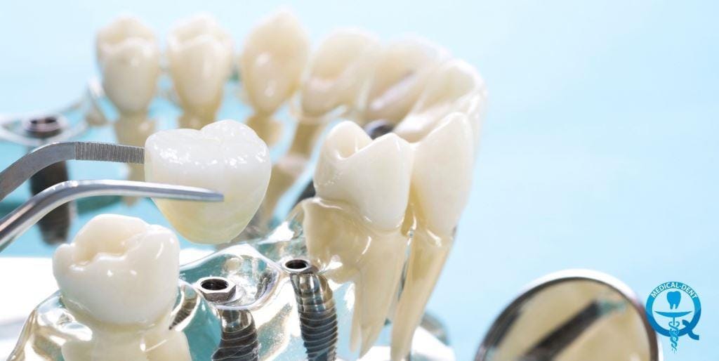 Dental model showing an implant and crown