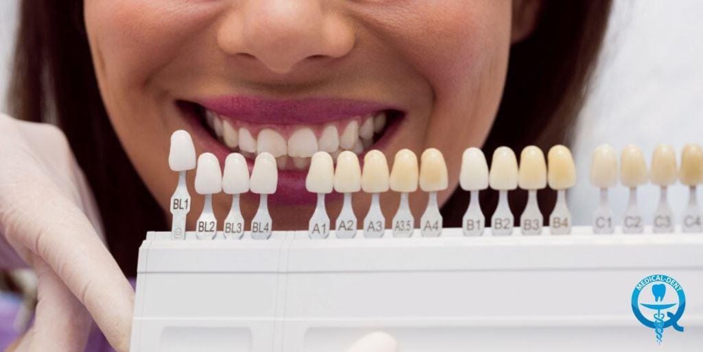 A tooth shade guide held in front of a smiling mouth