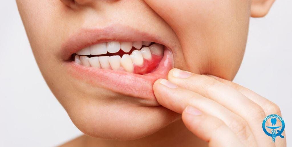 A person pulling down their lower lip to show the gum