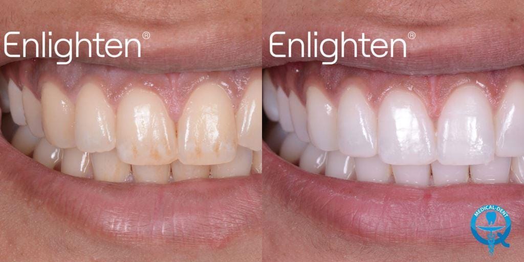 Two photographs of teeth in an Enlighten-branded comparison image
