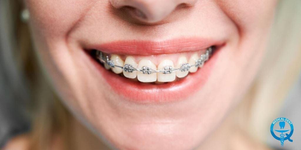 A close-up of a smile with fixed braces