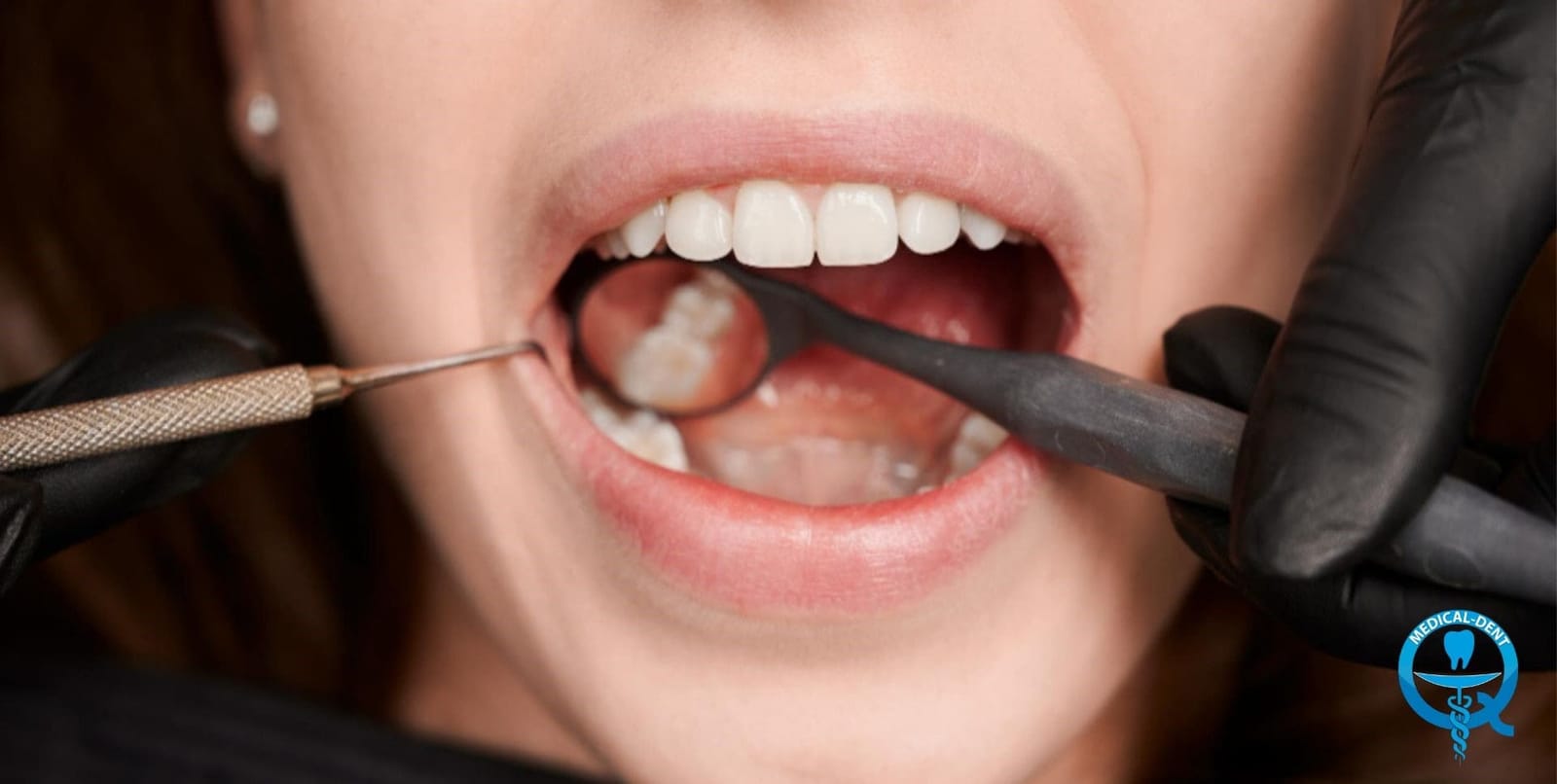 A patient’s mouth being examined with dental instruments