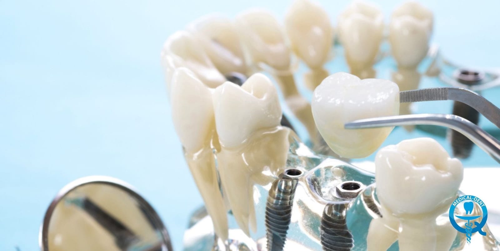 A dental model showing implants and a replacement tooth held above them