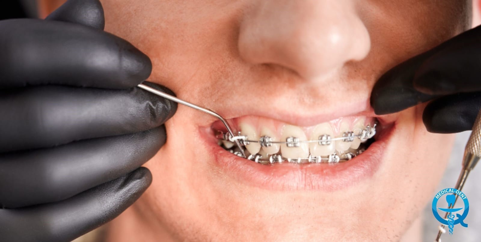 A clinician adjusting fixed braces