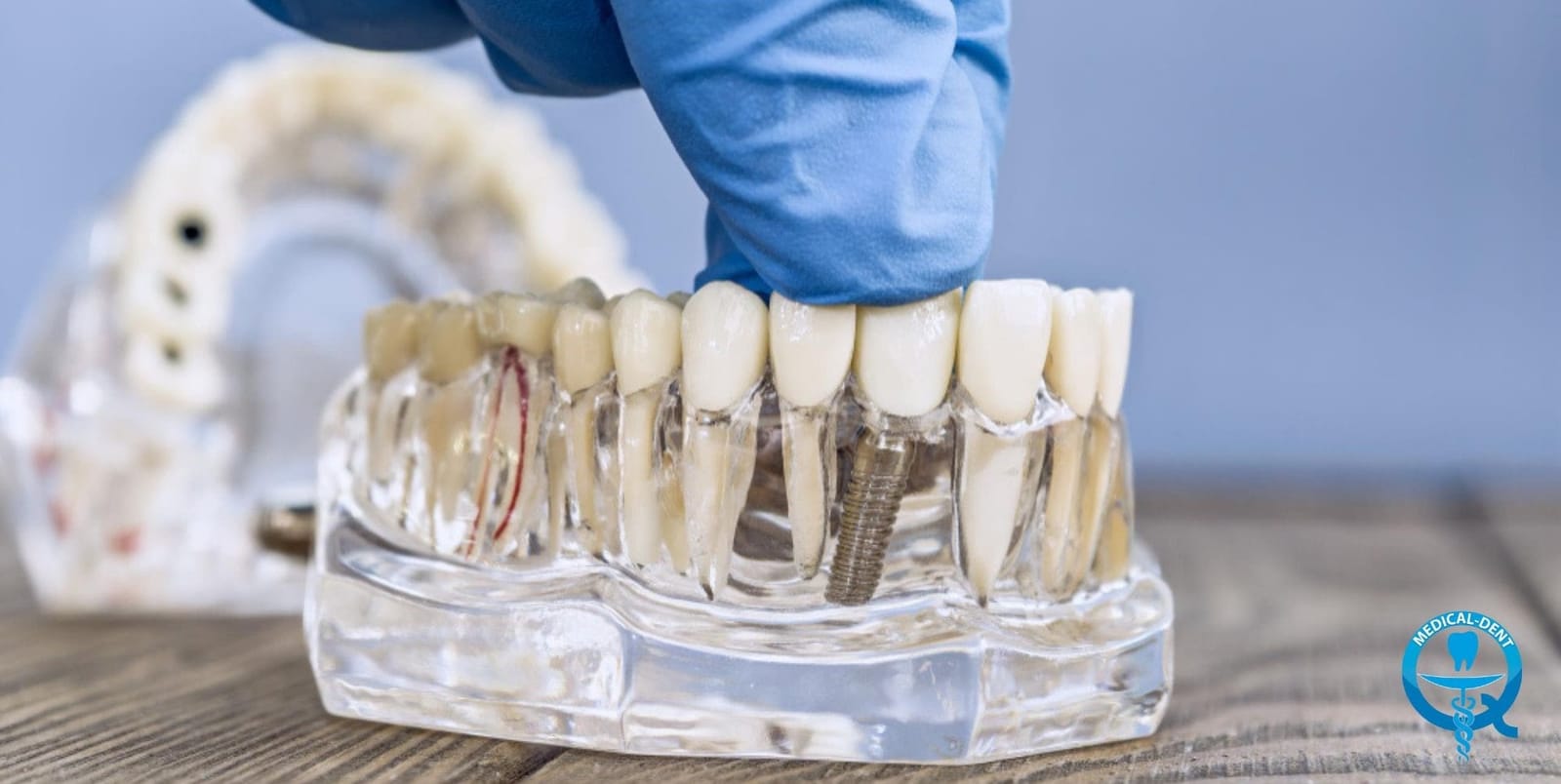 A transparent jaw model showing teeth and implant components