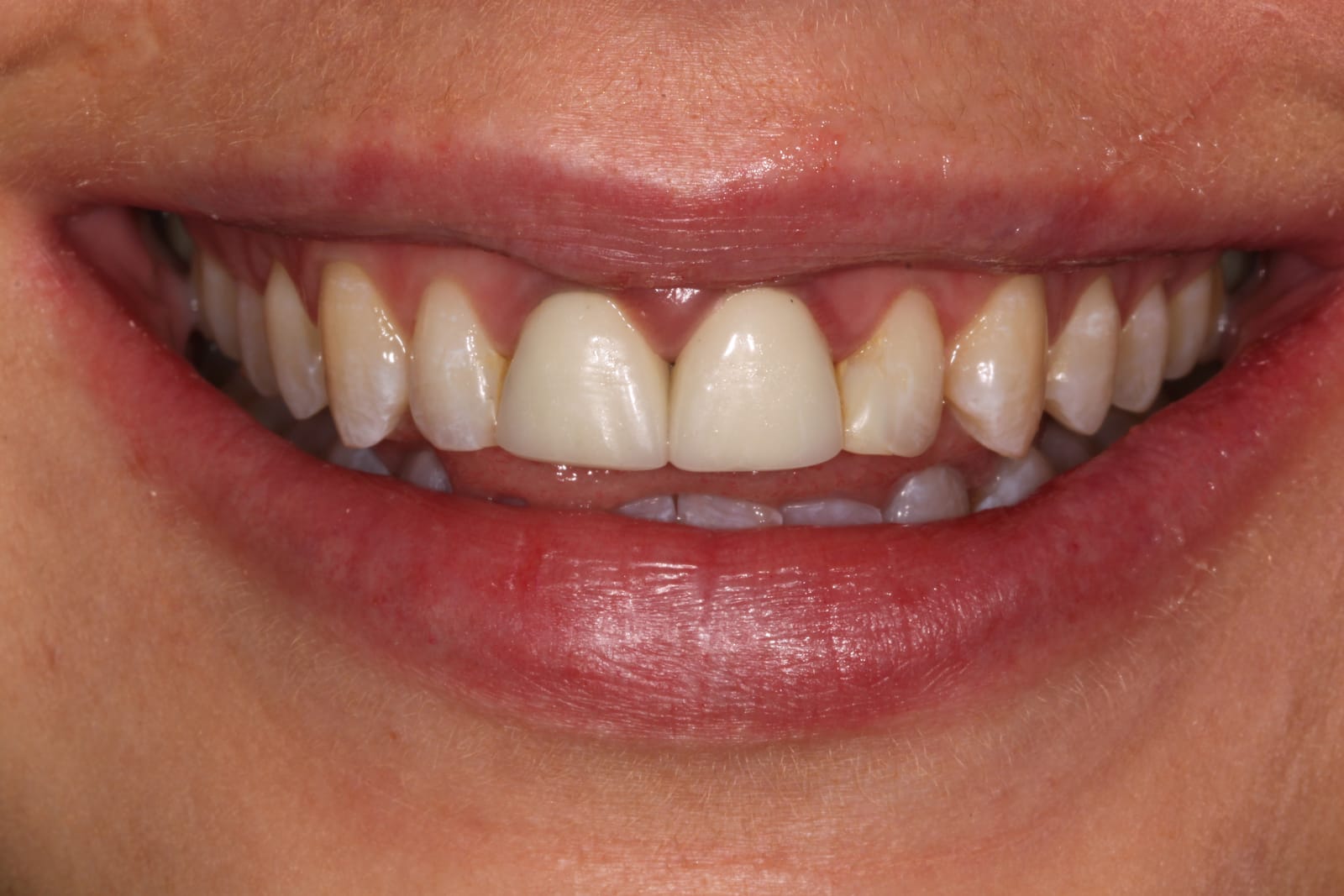 Close-up of upper teeth in a smiling mouth