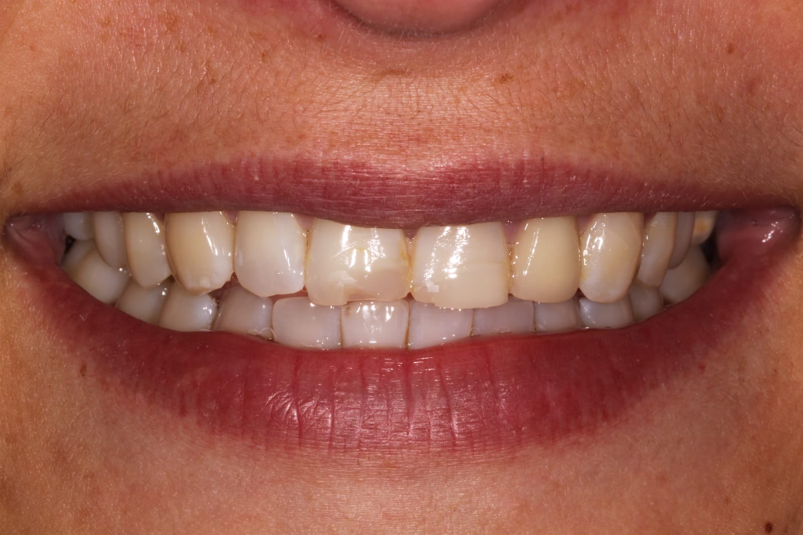 Close-up of a smile showing the upper front teeth