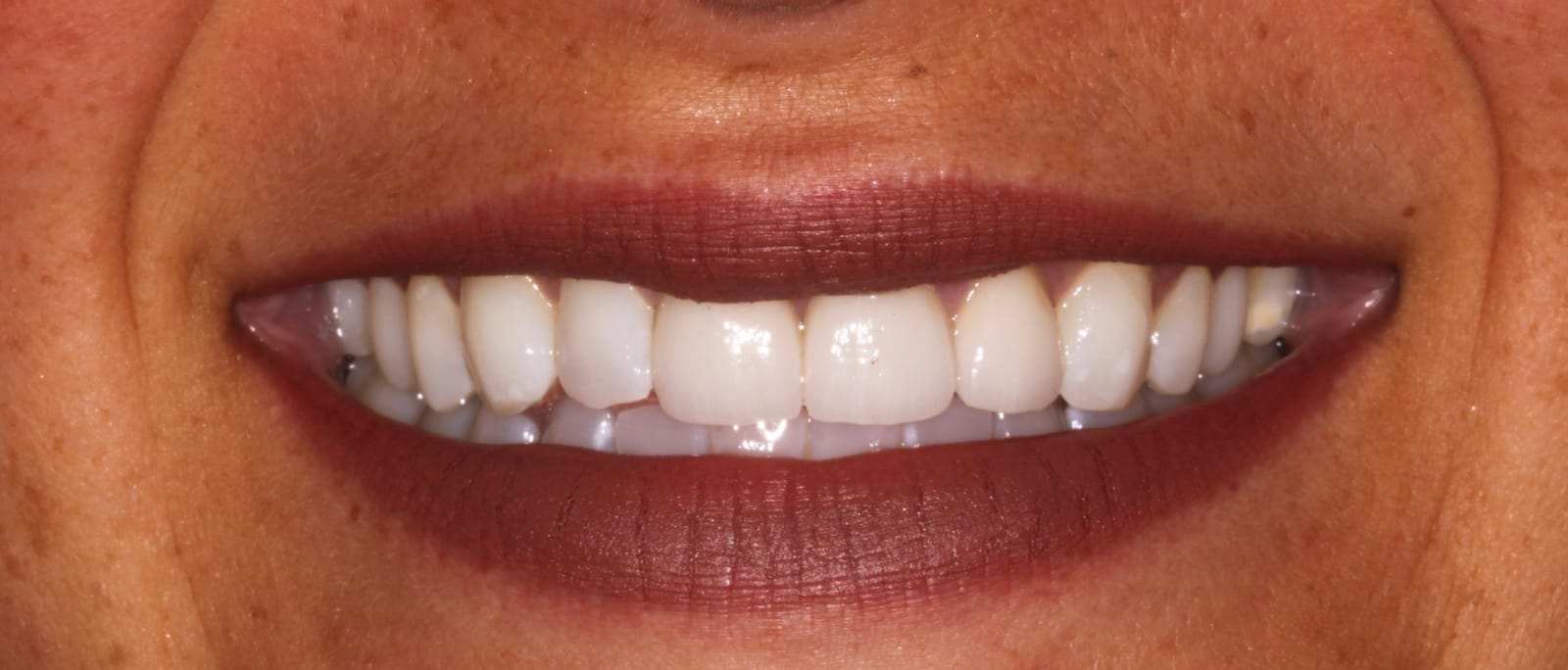 Close-up of a smile framed by dark pink lips