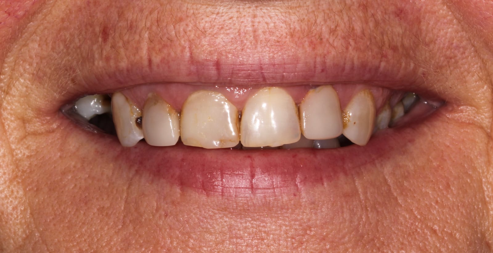 Close-up of a mouth with the upper front teeth visible