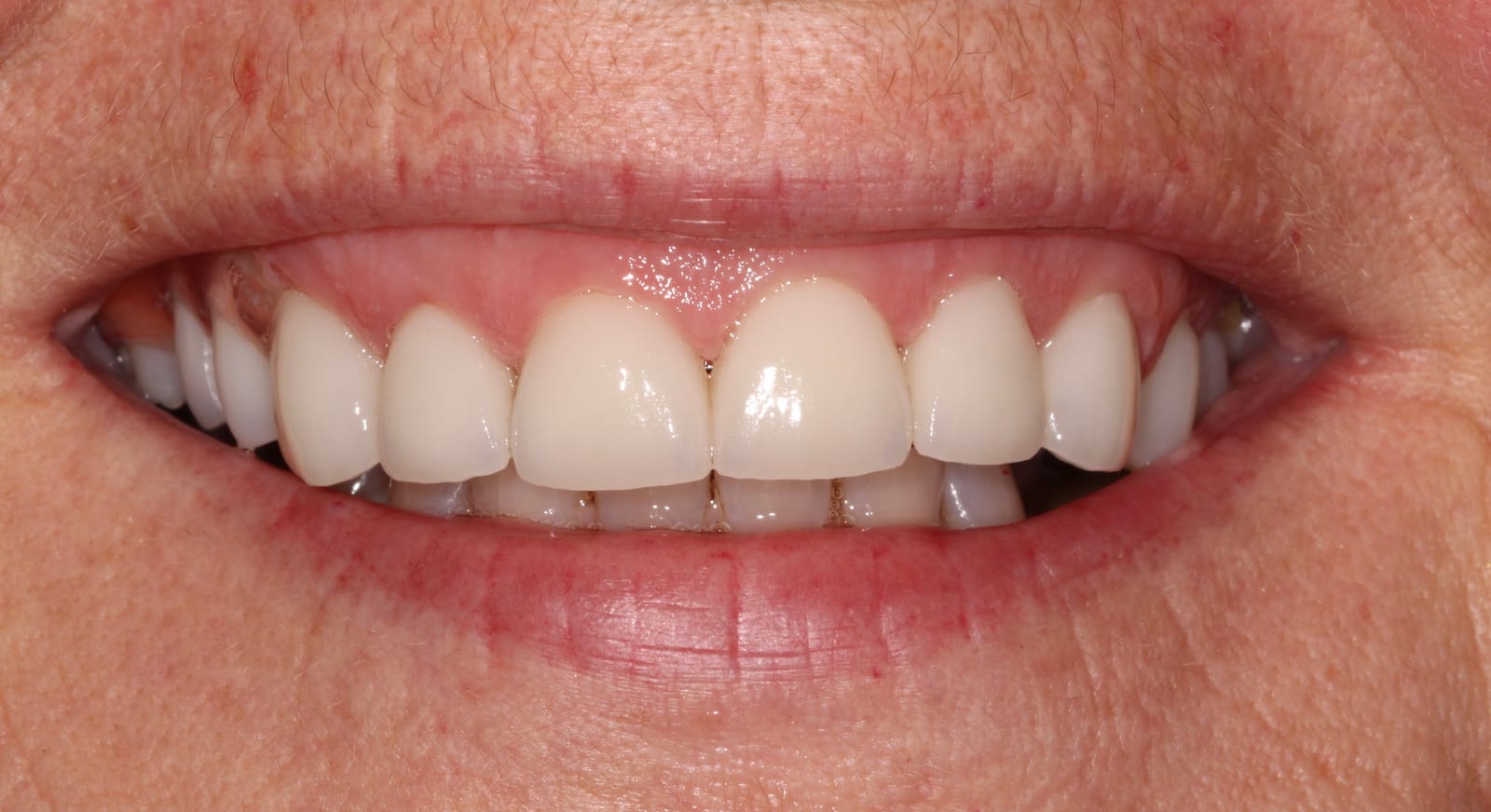 Close-up of a smile showing the upper and lower front teeth