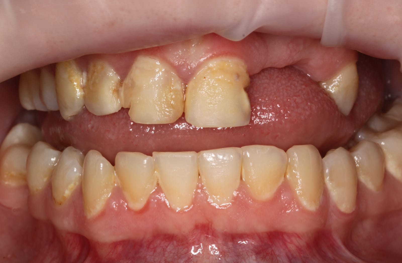Close-up of an open mouth showing upper and lower front teeth