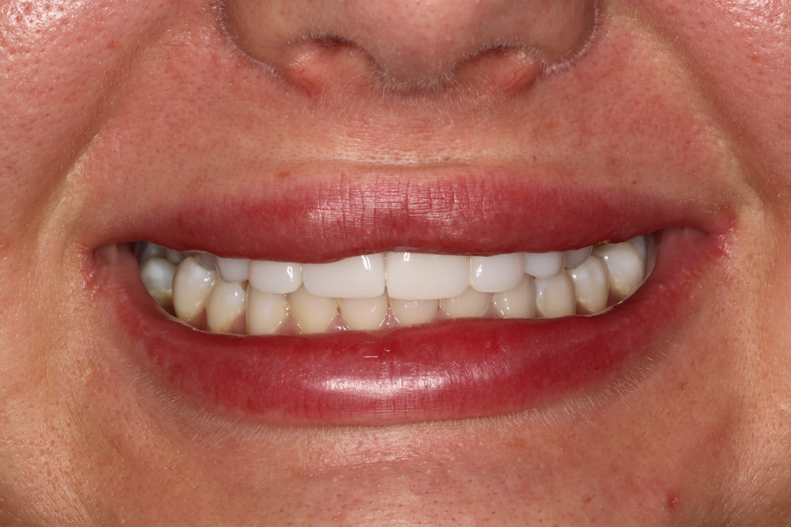 Close-up of a smile with the front teeth visible