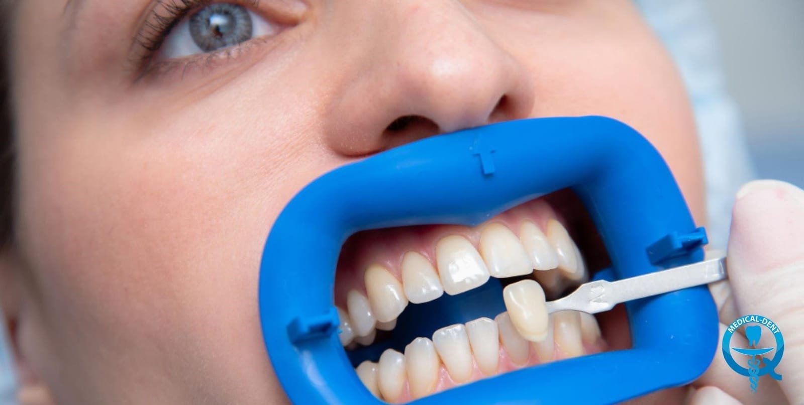 A tooth shade sample held beside a person’s upper front teeth
