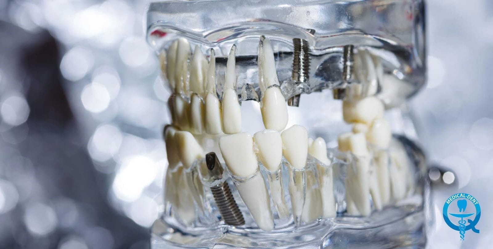 A transparent dental model showing teeth and implants
