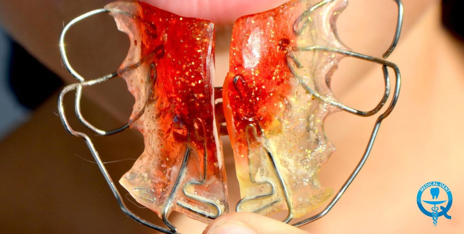 A removable orthodontic appliance with red acrylic and metal wires
