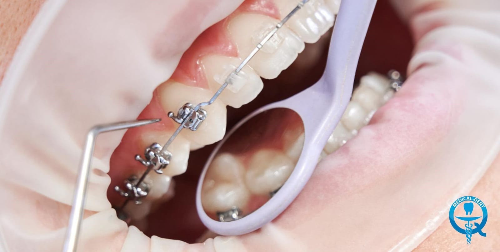 Close-up of fixed brackets being examined with dental instruments