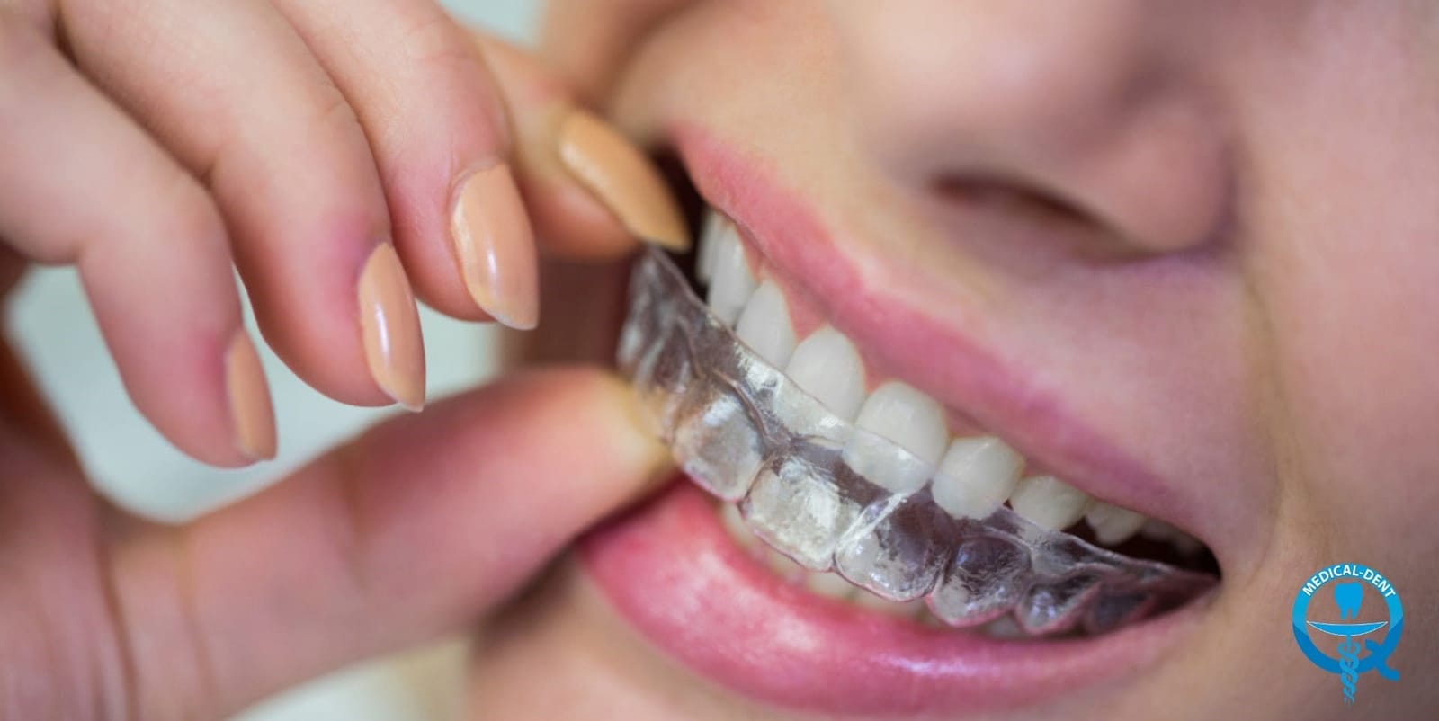 Person placing a clear aligner over their teeth