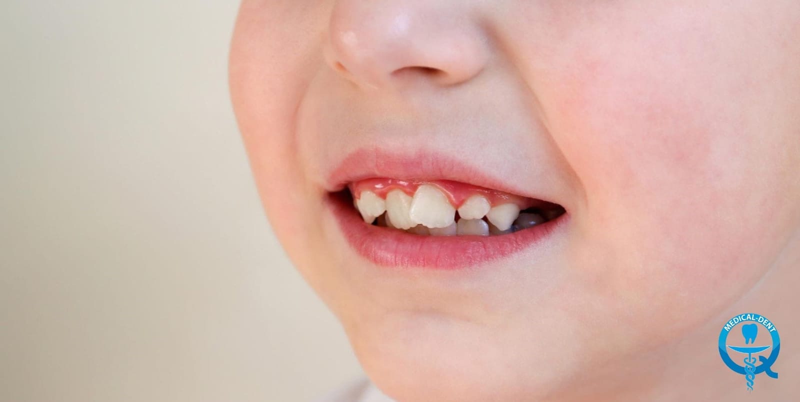 A close-up of a child’s front teeth